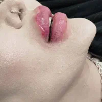 تزریق فیلیر بوتاکس فول تزریق آنزیم