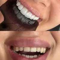 تخفیف ویژه کامپوزیت، روکش ...