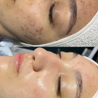 پاکسازی پوست فشیال با تخفیف ویژه