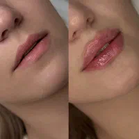 ریموو تتو / فیلر / ژل / بوتاکس / لیزر موهای زائد