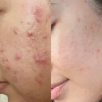 رفع قطعی و تضمینی جوش و جای جوش