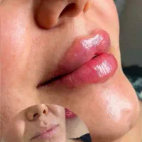 جشنواره تزریق فیلر و بوتاکس با قیمت استثنایی