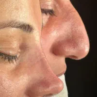 عمل بینی آف ویژه ۵۰درصدی در بیمارستان
