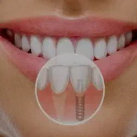 ایمپلنت کره‌ای اقساطی با روکش دیجیتال