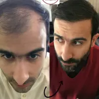 کاشت مو و ابرو کاملا تخصصی و حرفه ای|خدمات آرایشگری و زیبایی|تهران, نارمک جنوبی|دیوار