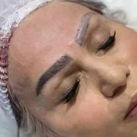 میکروکاشت در جشنواره با روش جراحی و بدون جراحی