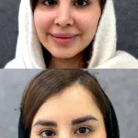 کاشت ابروی طبیعی با شرایط اقساطی