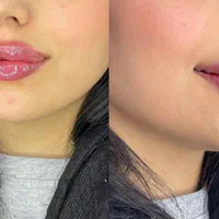 ژل ، بوتاکس ، لیزر و نخ گذاری توسط پزشک