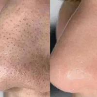صابون کربن اکتیو