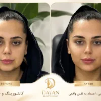 تخفیفات فیلر لب، بادی، بوتاکس، مزوژل و لیفت نخ