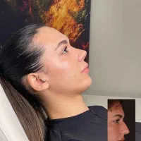 عمل جراحی بینی/مشاوره رایگان/لیفت صورت