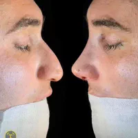 جراحی بینی عالی وهزاران جراحی بینی ترمیم شده موفق
