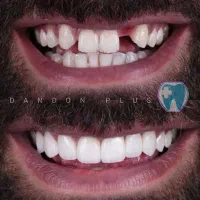 ایمپلنت سوئیسی و کره‌ای  نقد و اقساط ویژه
