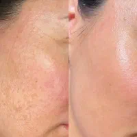 سرم تقویت کننده مژه کرم ضد جوش