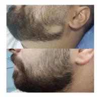تقویت خط ریش و پر کردن جای خالی مو