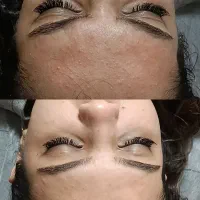 پاکسازی فیشال در کلینیک+ دوره آموزشی+مدرک