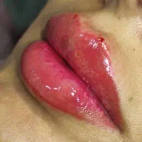 مدل فیلرلب وفول فیس هزینه مواد