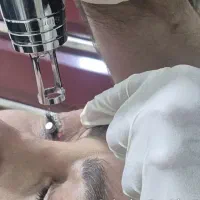 ریمو تتو با دستگاه کیوسوئیچ در مطب توسط پزشک