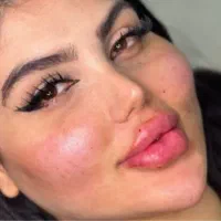 متخصص ژل و بوتاکس مزو و مزو ژل و آنزیم