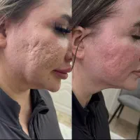 سابسیژن تخصصی جای جوش توسط خودپزشک ویزیت رایگان