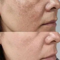 کرم ضدلک صورت وبدن تضمینی