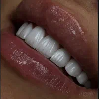 لمینیت و کامپوزیت در اقساط ویژه یودنتال