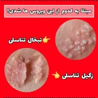 درمان قطعی زگیل و تبخال تناسلی