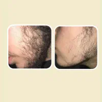 بهترین روش برای رویش