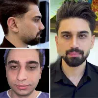 تخفیف جشنواره عمل بینی بلفارو ماموپلاستی ( اقساط)