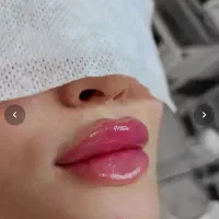 ژل لب و بوتاکس حرفه ای