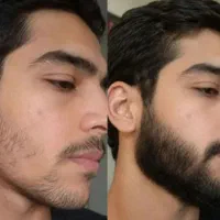 پوست سر سالم، موی بدون ریزش