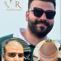 کاشت مو و ابرو فقط با ۵ملیون