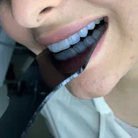 کامپوزیت لیرینگ لب شیشه فکی ۲۵ت