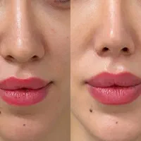 لیفت و کوچیک کردن بینی بدون جراحی
