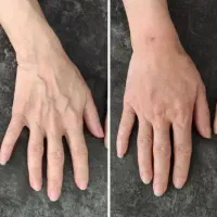 آموزش و خدمات فیلر بادی باسن بیکینی دست و پا