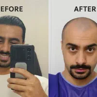 جشنواره کاشت مو ،ابرو و مژه قابل رشد