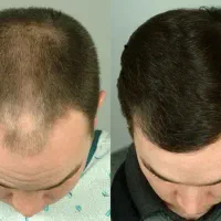 قطع ریزش و رویش مجدد مو