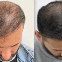 اگه موهات کم پشته پیام بده..