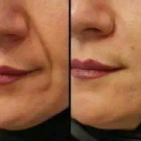 لک و جوش وچروک  رو ریشه کن تا همیشه
