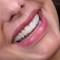 جشنواره کامپوزیت فقط از فکی ۳.۵ اقساطی،لمینیت،روکش