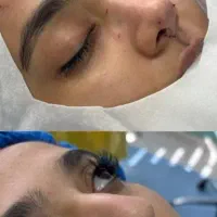 جراحی بینی اقساطی.بلفارو.لیپوابدو.لیفت شقیقه.