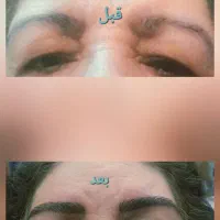 ریمو ابرو با دستگاه ومواد