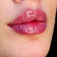 ژل و بوتاکس باتخفیف ویژه کلینیک زیرنظر پزشک