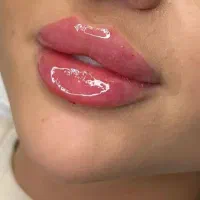 تزریق ژل و بوتاکس، تخفیف ویژه