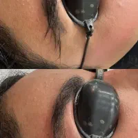 لیزرتخصصی ریموو تتو ابرو و تتوبدن رفع لک و جای جوش