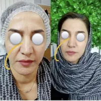 جدیدترین روش زیبایی کاملا غیر تهاجمی زیر نظر پزشک