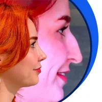 عمل بینی با جدیدترین روش جراحی