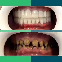 اوردنچر با ۴ پایه، کیفیت قابل قبول
