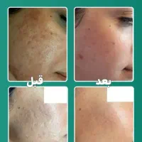 لیزر جوانساز و رفع لک و مک و تیرگی CO2 فرکشنال
