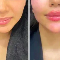 ژل بوتاکس انزیم مزو تراپی